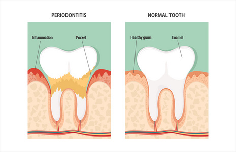 牙牙周疾病