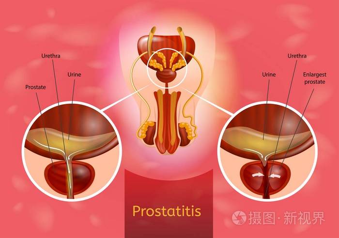 前列腺炎现实矢量医疗方案