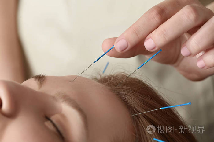 女人接受针灸治疗