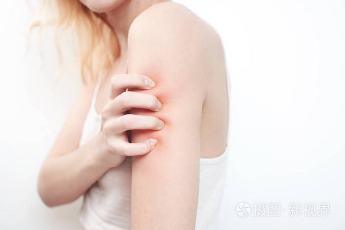 女人抓臂特写皮肤发痒的概念