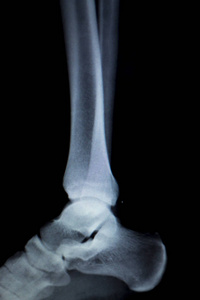 X 射线的脚踵踝关节扫描