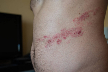 闭上腹部带状疱疹照片