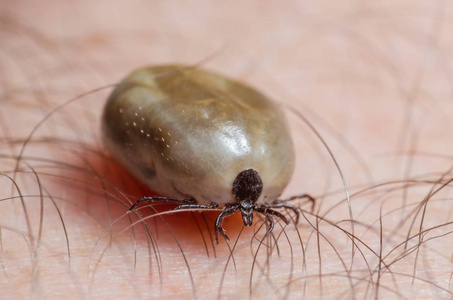 满腔热血坐在人体皮肤上的蜱虫照片
