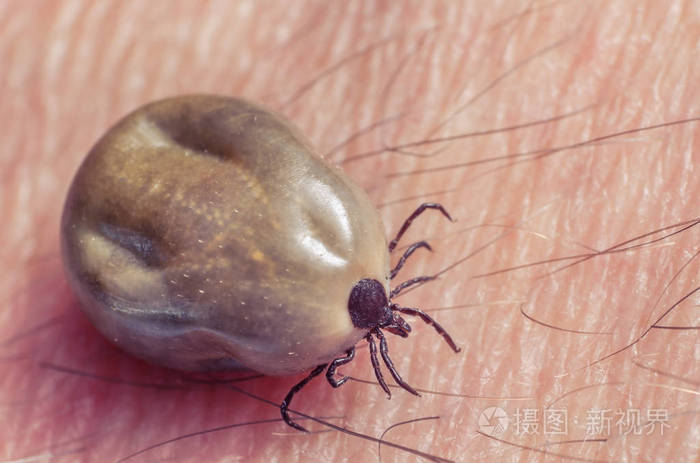 满腔热血坐在人体皮肤上的蜱虫