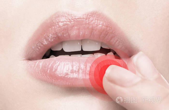 女性嘴唇疱疹病毒照片 正版商用图片0png2e 摄图新视界 女性嘴唇疱疹病毒照片 正版商用图片0png2e 摄图新视界