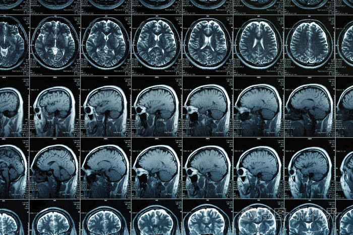 磁共振成像或磁共振图像的头部和大脑扫描关闭了视图