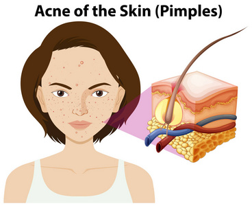 皮肤痤疮在妇女例证