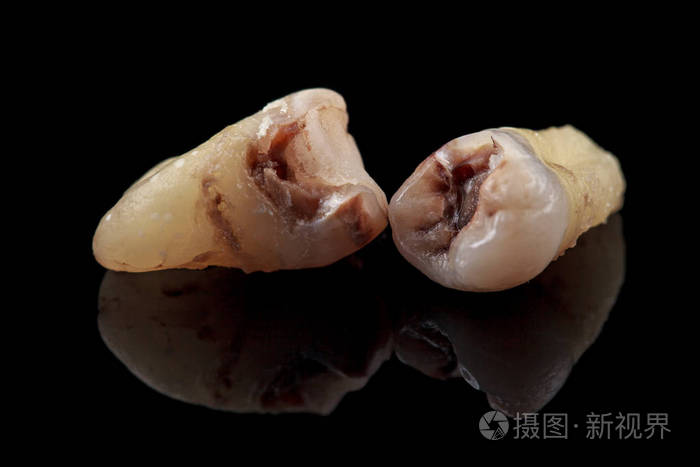 已删除的牙齿龋在黑色背景上的损坏宏观