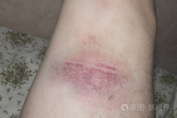 膝盖受伤了髌骨脱位膝盖肿胀