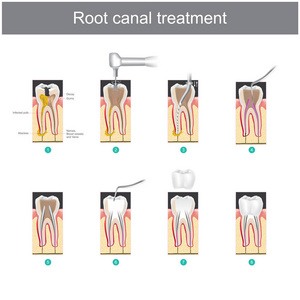 根管治疗。牙齿损坏后如何治疗我们的牙齿。或严重龋齿引起的感染或炎症