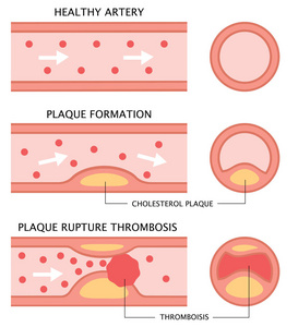 健康的动脉, 斑块的形成, 以及在白色背景下被隔绝的扁平型血栓形成
