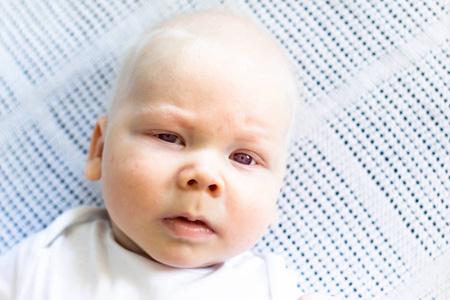 怀特黑尔 babyboy 白化病综合征照片