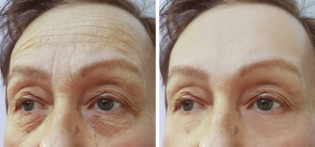面部老年妇女额头皱纹的美容程序前后