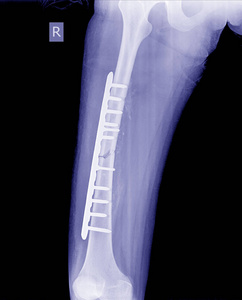 骨折股骨断腿 x 线图象骨板和螺钉的断裂腿 股骨 x 射线图像