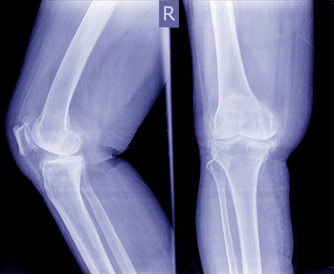 骨关节炎 Oa 膝部。膜 x 线 Ap 前后 和侧视的膝关节显示狭窄的关节空间, 赘 骨刺, 软骨下硬化, 膝关节炎