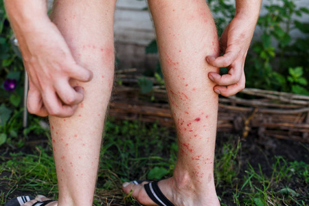 皮肤瘙痒公园里草地上的脚菌瘙痒.