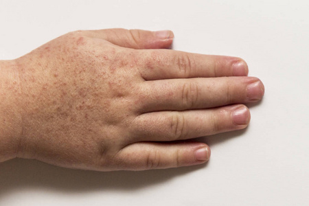 猩红红花菜豆猩红热.两个孩子手里有传染性的红色小皮疹.白色背景照片