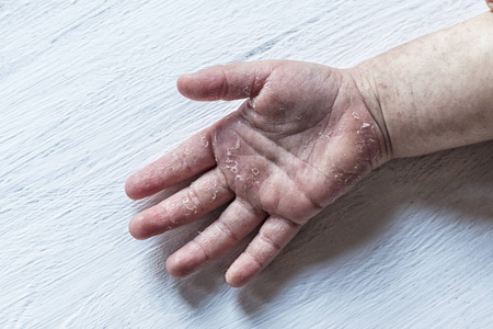 猩红热.两个孩子手里有传染性的红色小皮疹.白色背景照片