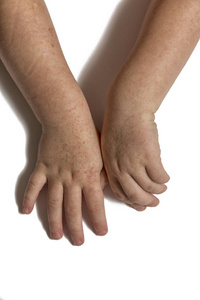 猩红热.两个孩子手里有传染性的红色小皮疹。白色背景