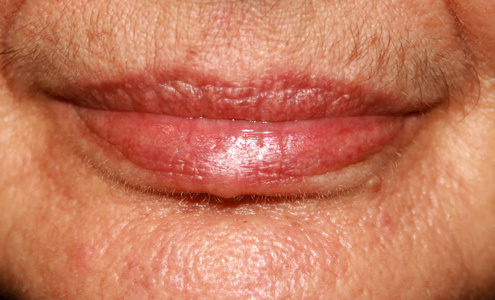 嘴部周围的皱纹照片