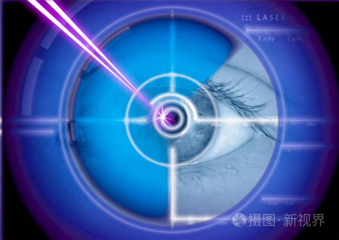 眼睛激光手术,激光矫正眼睛更正