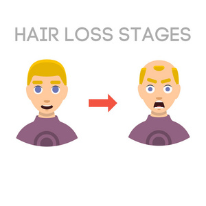 信息图表的脱发阶段类型的秃头男头矢量图所示