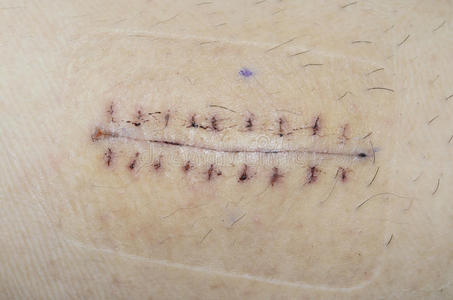 缝合后剖宫产外科缝合信息图集女性腿部皮肤活检后缝合的伤口.