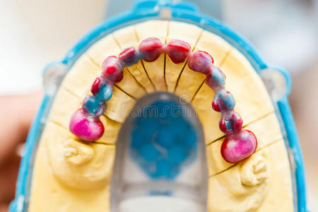 蜡质义齿模型