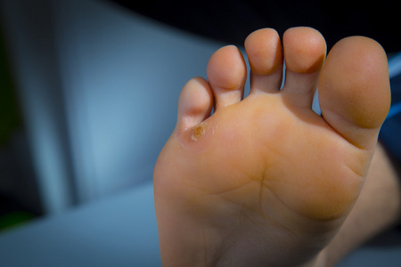 脚趾老茧脚上的老茧照片