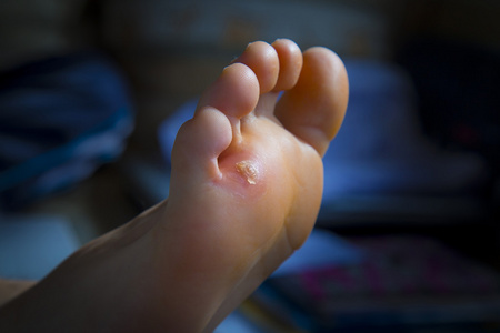 脚趾老茧脚上的老茧照片