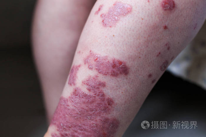 寻常型银屑病是一种影响皮肤的自身免疫性疾病 主要是医学杂志的详细摄影 特应性皮炎或湿疹 是一种在足部皮肤 发炎的类型照片 正版商用图片0qnkdj 摄图新视界