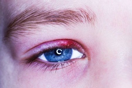 麦粒肿孩子眼睛红红的皮肤大麦细菌病毒照片