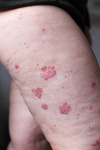 寻常型银屑病是一种影响皮肤的自身免疫性疾病, 主要是医学杂志的详细摄影。特应性皮炎或湿疹, 是一种在足部皮肤发炎的类型
