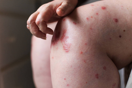 腿痒女人用手抓痒的腿.牛皮癣或湿疹皮肤照片