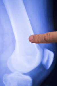 膝外伤外科植入 x 线扫描
