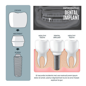 信息图表牙科植入结构信息海报