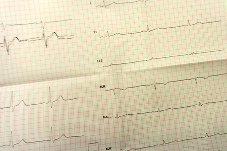 心电图心脏病学分析分析节拍图片
