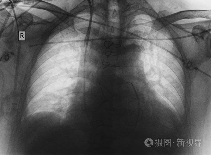 心脏和部的 x 射线图像