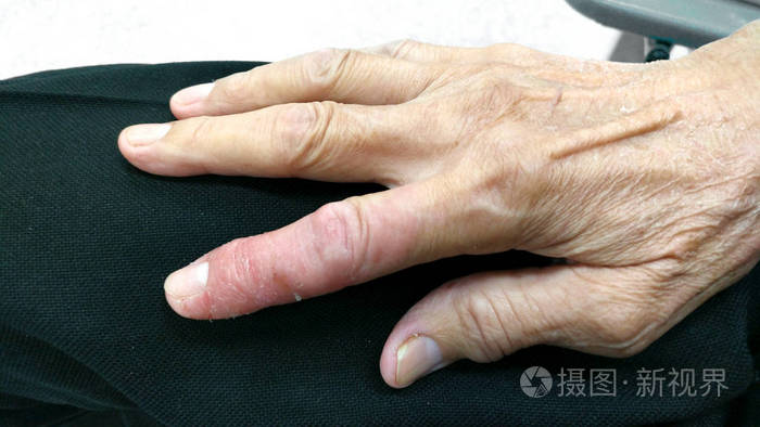 感染的皮肤开始脱落.真菌感染.手指