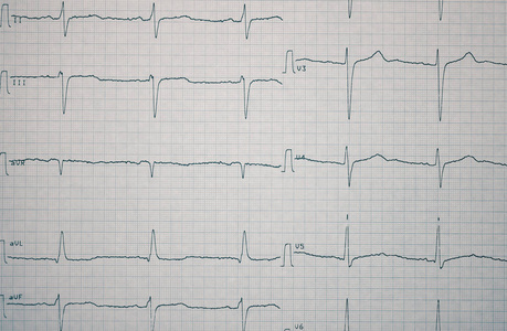 心电图记录作为医学背景纸上