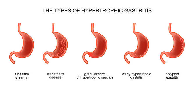 类型的肥厚性胃炎