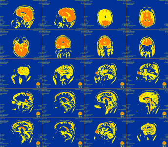 磁共振成像的大脑图片