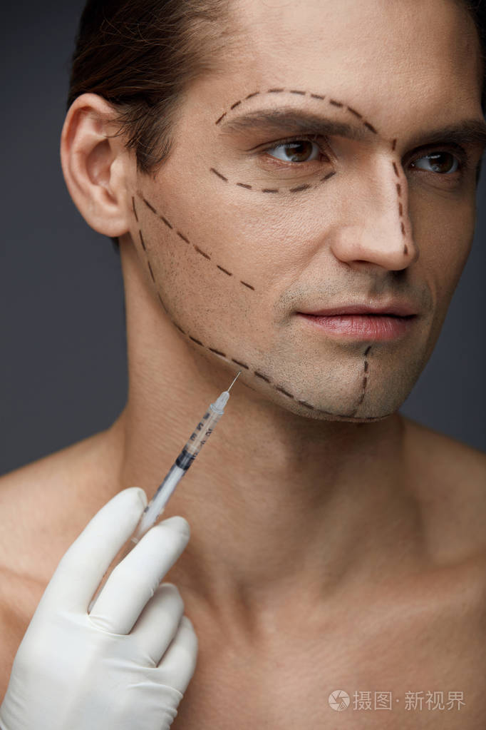 整形手术.英俊的男人脸线条变得注射