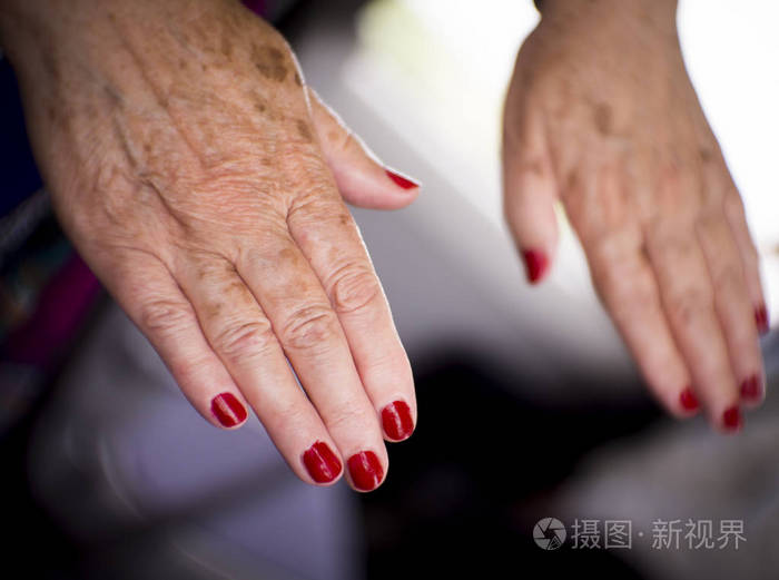 中年妇女的手风湿病骨关节炎和皮肤瑕疵的问题
