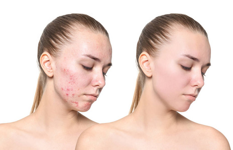 年轻女性痤疮治疗前后的白色背景。护肤理念