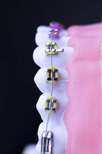 牙科金属牙直线对准器固定器的教学正畸模型