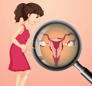 妇女与卵巢癌例证