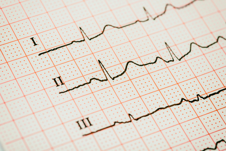 窦性心律心电图记录纸上显示正常的 P 波，公关和 Qt 间期和 Qrs 复合波