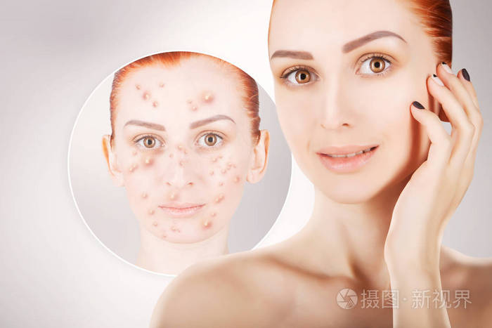 痤疮问题,红头发的女人肖像