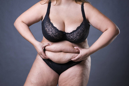 女人与脂肪腹部，超重女性的胃，妊娠纹肚皮特写